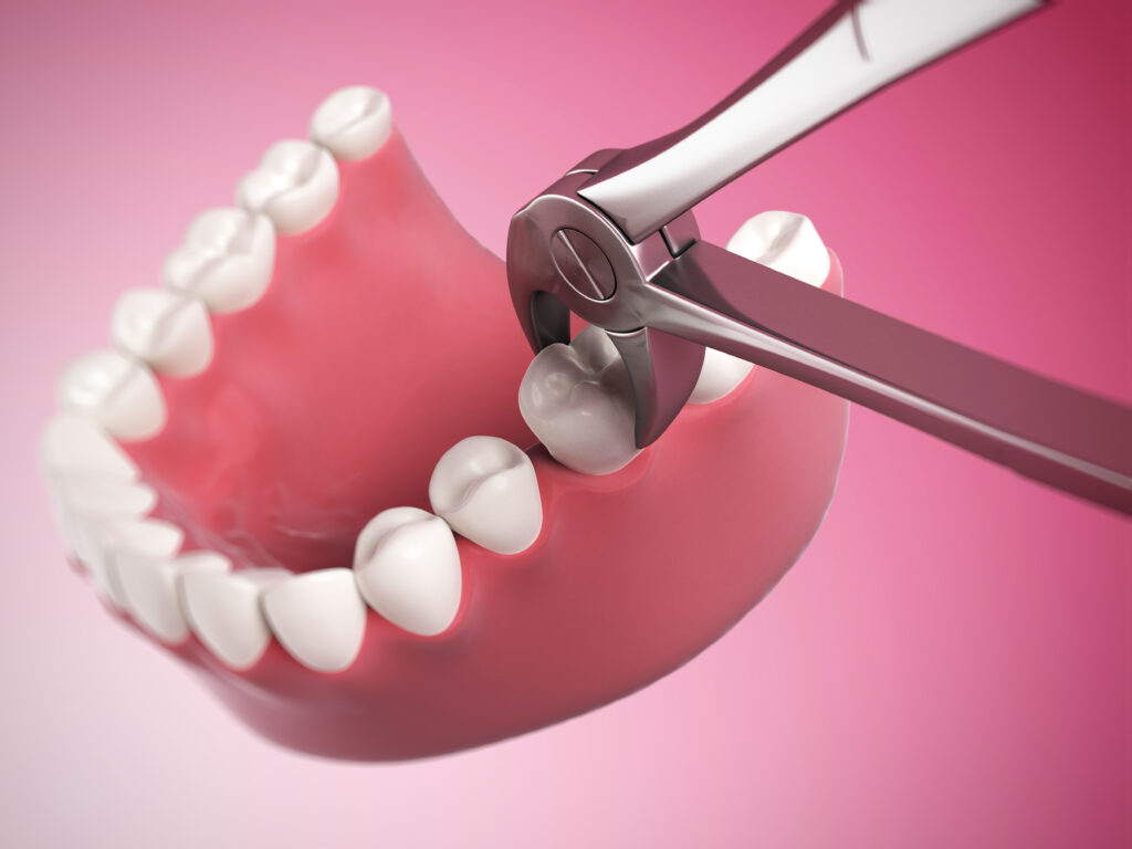 5 Common Reasons Why Tooth Extractions May Be Necessary