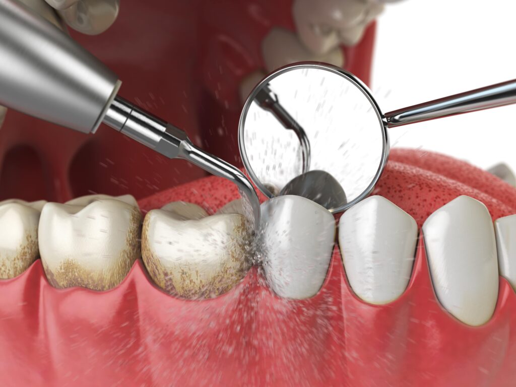 Dental Cleanings: Promoting Optimal Oral Health