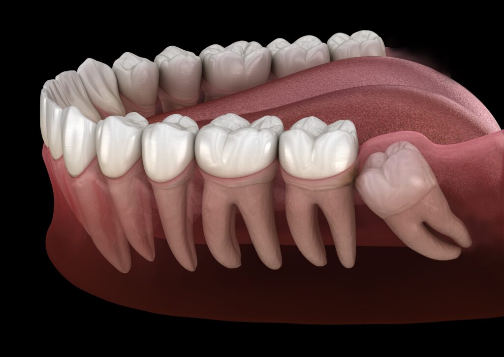 Pain Management After Wisdom Teeth Extraction: What You Need to Know