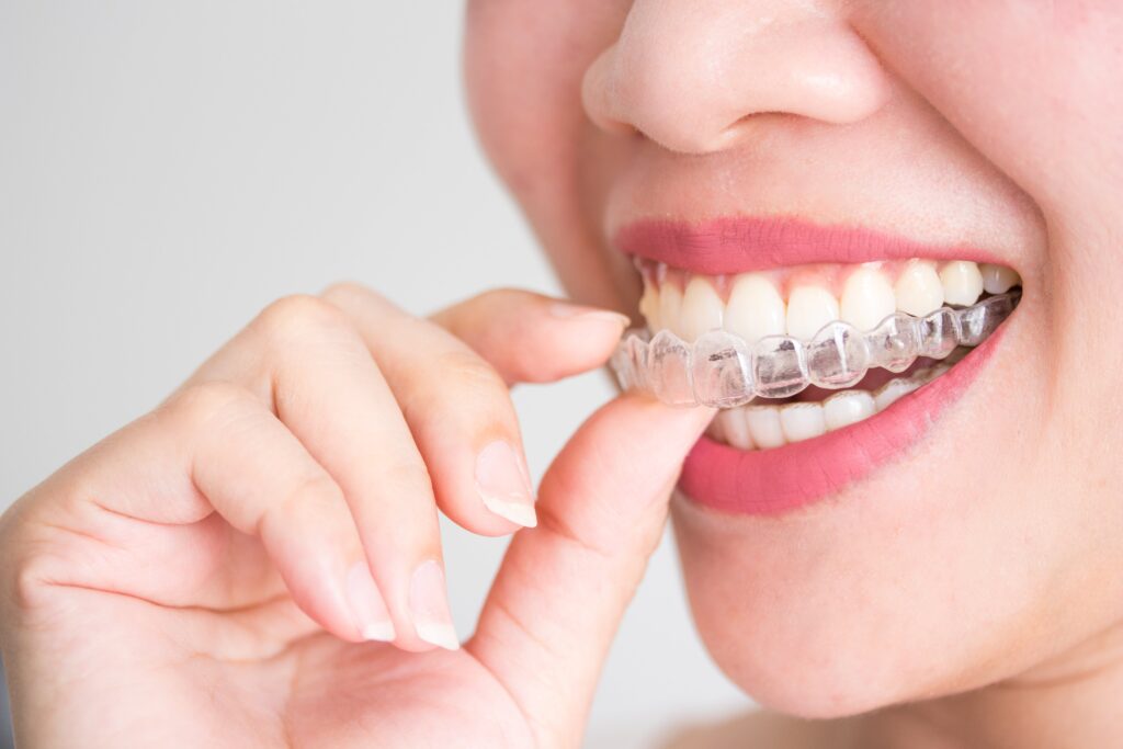 How to Maintain Your Smile After Invisalign: Tips from Your Dentist