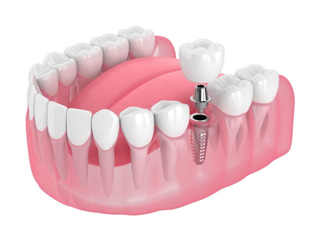 Do Dental Implants Feel Like Real Teeth What You Need to Know